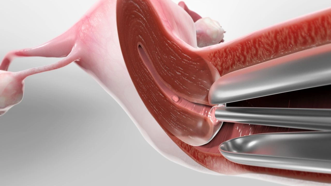 hysteroscopy_1280
